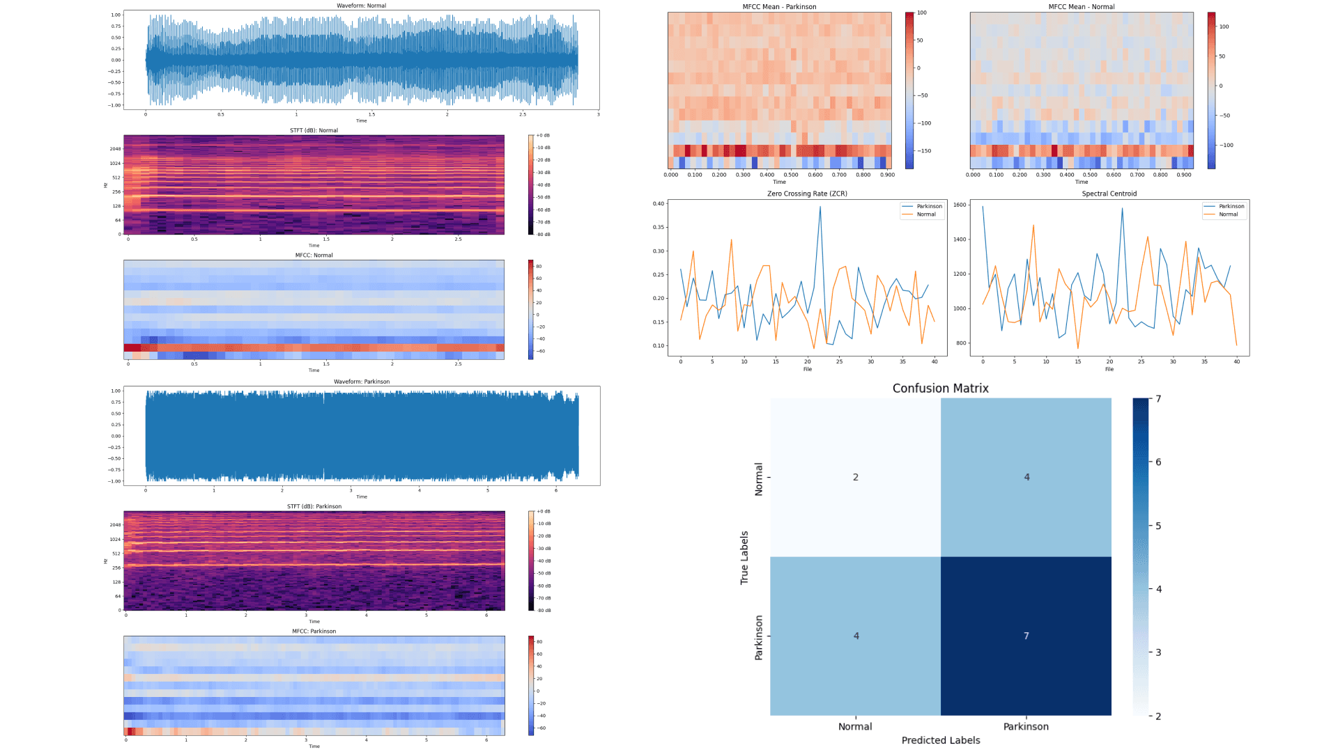 Parkinson Disease Detection from Soundawave with Artificial Intelligence